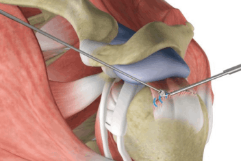 rotator cuff surgery